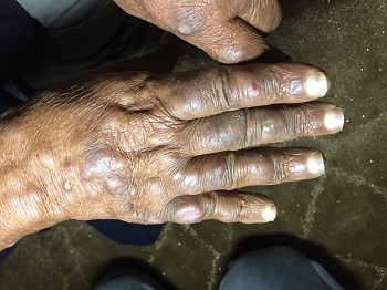 Hands of leprosy patient