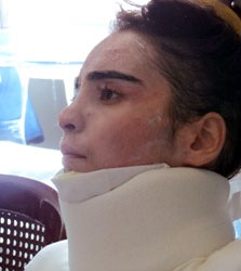 L'image nous montre Jinan, étudiante en géographie, qui souffre de graves brûlures au niveau des bras, des jambes, du cou et de la poitrine, après une forte explosion qui a eu lieu près de chez elle, à Damas. Elle est actuellement traitée à l’hôpital al-Mouwassat.