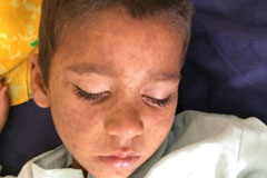 A child with skin disease in Bannu, Khyber Pakhtunkhwa