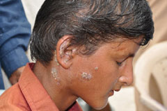 This boy has developed a skin disease following the flood in Thatta, Sindh 2011