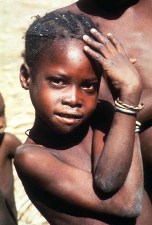 À Wayen, à l'est de Ouagadougou, une fillette montre les modifications cutanées précoces associées à l’onchocercose.