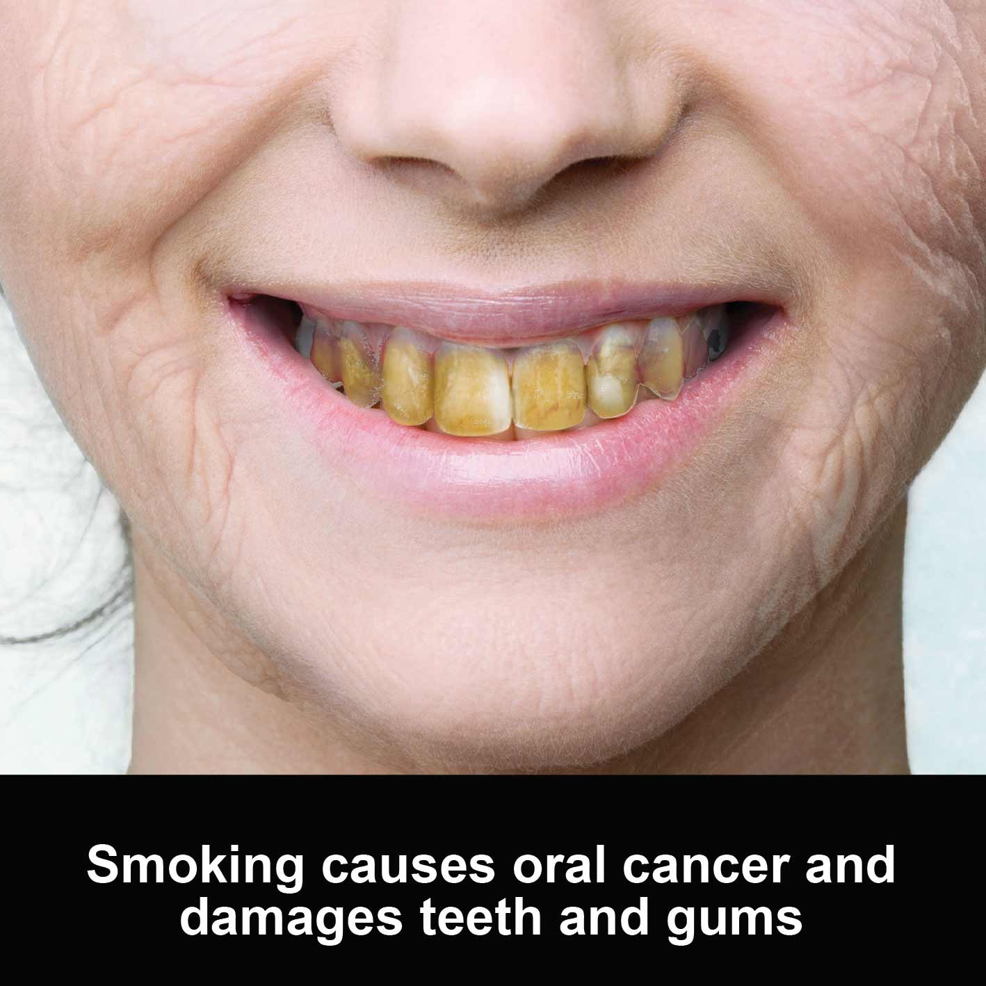 smoking-causes-oral-cancer