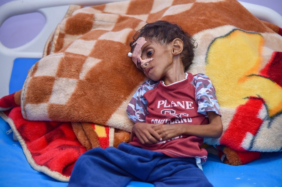 malnourished-child-yemen
