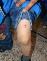 Genou d'un enfant présentant une lésion, à Alep. En Syrie, on recherche activement les cas de leishmaniose cutanée anthroponotique due à L. tropica.