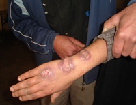 Lésions dues à la leishmaniose cutanée zoonotique (à L. major) dans un foyer émergent au Maroc.