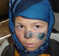 Enfant afghan présentant des lésions au visage dues à la leishmaniose cutanée anthroponotique causée par L. tropica