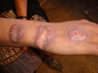 Photographie d'un bras gravement marqué par des lésions de la peau dues à la leishmaniose