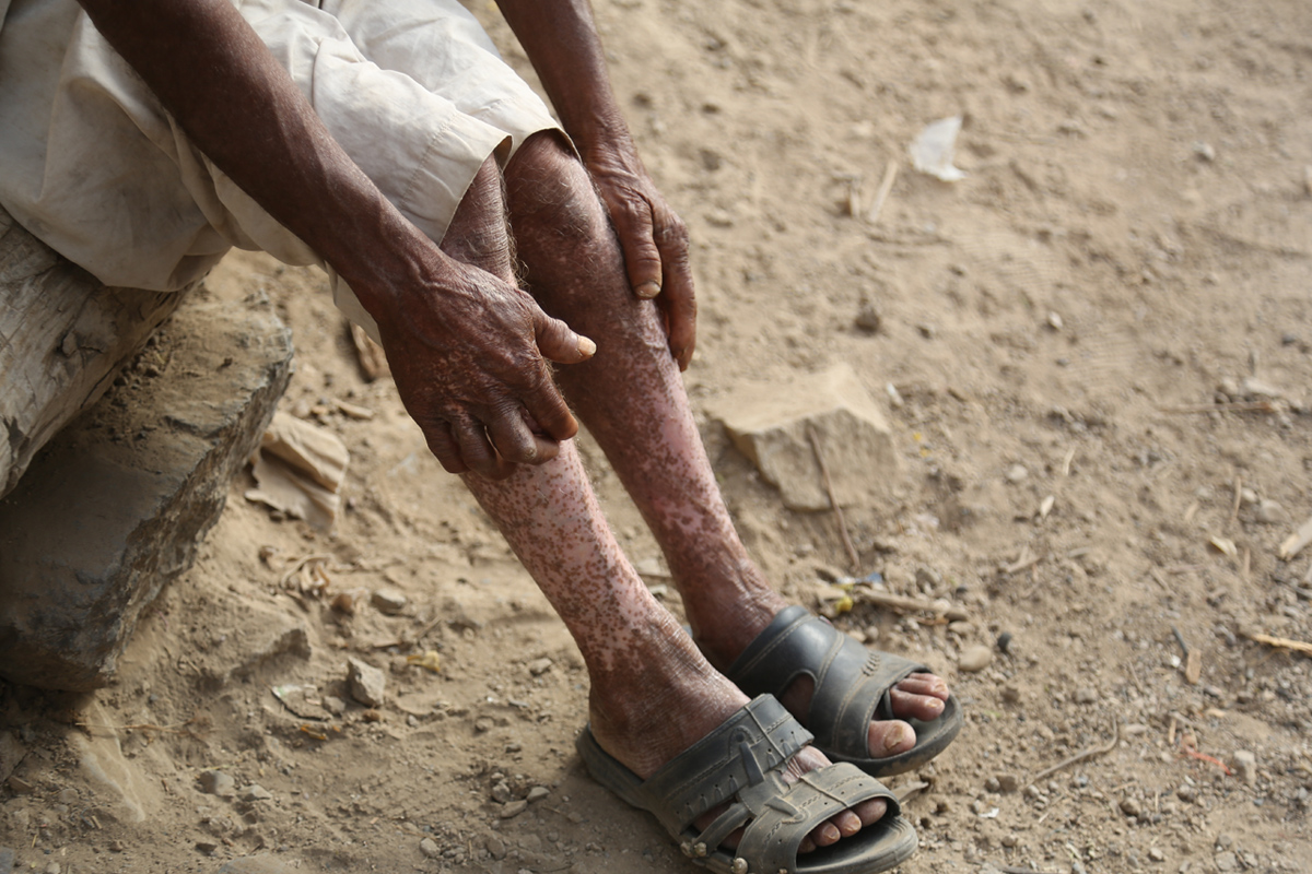 على عكس ما يحدث في أفريقيا، لا يوجد في اليمن أي سجلات عن المضاعفات التي تصيب العين أو تسبب العمى نتيجة لداء كلابية الذنب. ويظهر المرض في إصابات موضعية، ﻻ سيما في أسفل الساقين، على أنه 