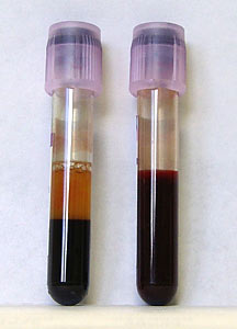 أنبوبة اختبار تحتوي على دم