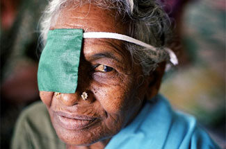 Image of an older woman wearing a bandage over one eye after receiving cataract surgery