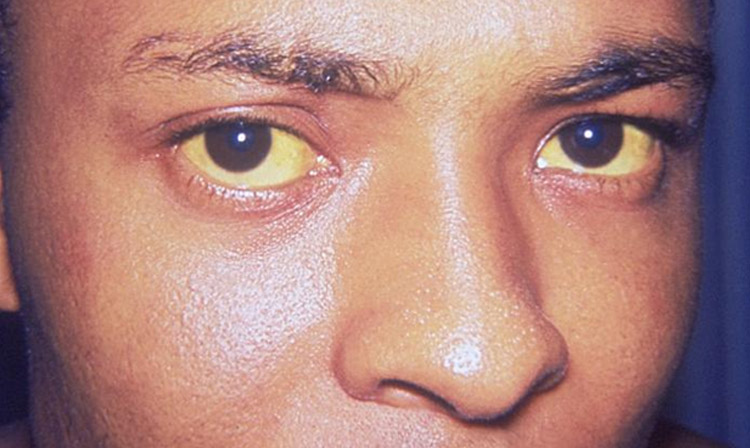 Hepatitis can cause jaundice, or a yellowing of the skin and eyes, due to bile duct obstruction (Photo: Dr. Thomas F. Sellers, Emory University/CDC)