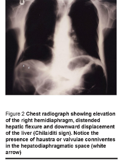 Figure 2 Chest radiograph showing elevation of the right hemidiaphragm, distended hepatic flexure and downward displacement of the liver (Chilaiditi sign). Notice the presence of haustra or valvulae conniventes in the hepatodiaphragmatic space (white arrow)