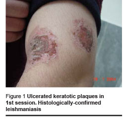 Figure 1 Ulcerated keratotic plaques in 1st session. Histologically-confirmed leishmaniasis