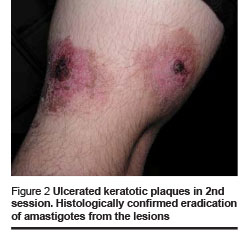 Figure 2 Ulcerated keratotic plaques in 2nd session. Histologically confirmed eradication of amastigotes from the lesions