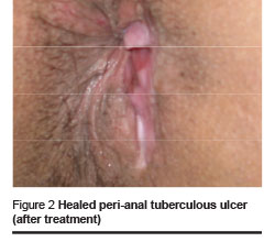 Figure 2 Healed peri-anal tuberculous ulcer  (after treatment)