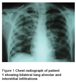 Figure 1 Chest radiograph of patient 1 showing bilateral lung alveolar and interstitial infiltrations