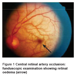 Figure 1 Central retinal artery occlusion: funduscopic examination showing retinal oedema (arrow)