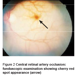Figure 2 Central retinal artery occlusion: funduscopic examination showing cherry red spot appearance (arrow)