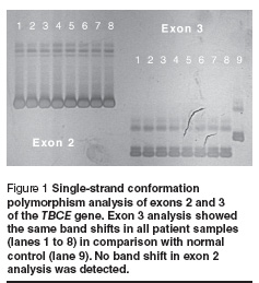 Figure 1 Single-strand conformation  polymorphism analysis of exons 2 and 3  of the TBCE gene. Exon 3 analysis showed  the same band shifts in all patient samples  (lanes 1 to 8) in comparison with normal  control (lane 9). No band shift in exon 2  analysis was detected.
