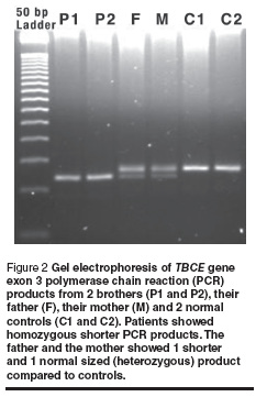 Figure 2 Gel electrophoresis of TBCE gene  exon 3 polymerase chain reaction (PCR)  products from 2 brothers (P1 and P2), their  father (F), their mother (M) and 2 normal  controls (C1 and C2). Patients showed  homozygous shorter PCR products. The  father and the mother showed 1 shorter  and 1 normal sized (heterozygous) product  compared to controls.