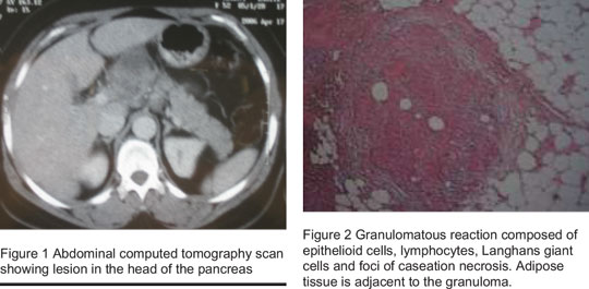 Figure 1 Abdominal computed tomography scan showing lesion in the head of the pancreas - Figure 2 Granulomatous reaction composed of epithelioid cells, lymphocytes, Langhans giant cells and foci of caseation necrosis. Adipose tissue is adjacent to the granuloma.
