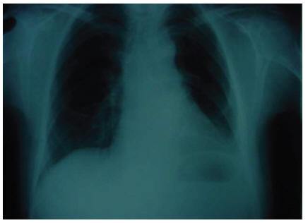 Figure 3 Chest X-ray showing no abnormality 2 months after surgery