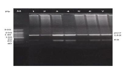 Figure 2 Detection of the HFE H63D mutation by PCR-RFLP with H63D primers and digested with restriction enzyme Bcl1. Lane M: DNA marker. Lanes 1, 5, 6 & 7: normal H63D wild allele digested bands (138 & 69 pb). Lanes 3 & 4: heterozygotes for H63D mutant allele showing normal digested bands (138 & 69 pb) as well as the undigested amplified fragment (207 pb). Lane 2: homozygote for H63D mutant allele show undigested band (207 pb).