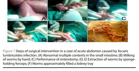 Figure 1 Steps of surgical intervention in a case of acute abdomen caused by  Ascaris lumbricoides infection. (A) Abnormal multiple contents in the small  intestine; (B) Milking of worms by hand; (C) Performance of enterotomy; (D, E)  Extraction of worms by sponge-holding forceps; (F) Worms approximately filled a  kidney tray