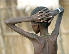 طفل مصاب بسوء التغذية في مركز التغذية التكميلية في عجيب، السودان