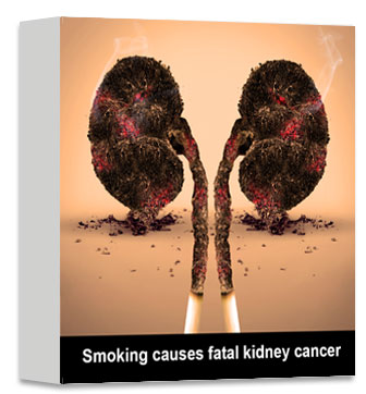 Fumer provoque le cancer mortel du rein