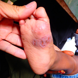 The burden of scabies is not known